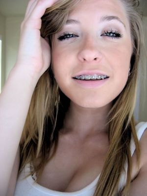 sexy girl braces